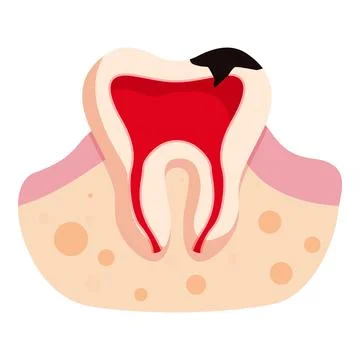 Deep tooth decay showing pulp and root canal on white background イラスト素材