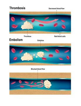 Deep vein thrombosis of legs. Image of healthy and diseased veins. illustra.. Stock Illustration