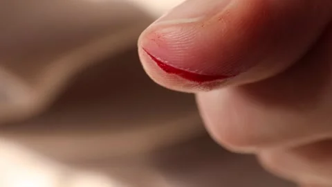 Deep wound on thumb caused by knife cut. Stock Footage 292245782