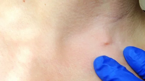 Defect on the skin, pinch. Stock Footage 96773593