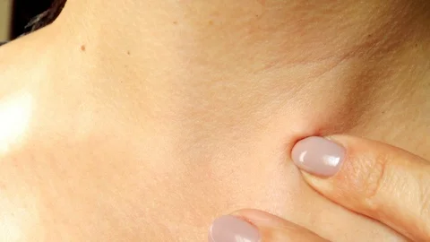 Defect on the skin, pinch. Stock Footage 96774595