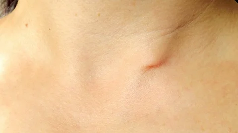 Defect on the skin, pinch. Stock-Footage 96904999