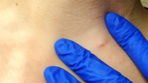 Defect on the skin, pinch. Stock-Footage 97082296