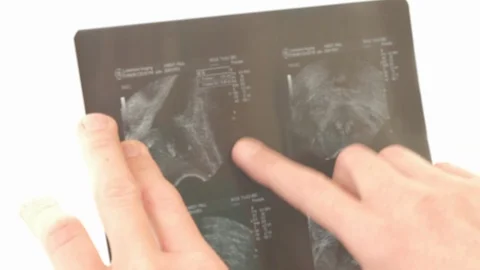 Defocussed close-up view of a doctor examining an X-Ray Stock Footage 87005170