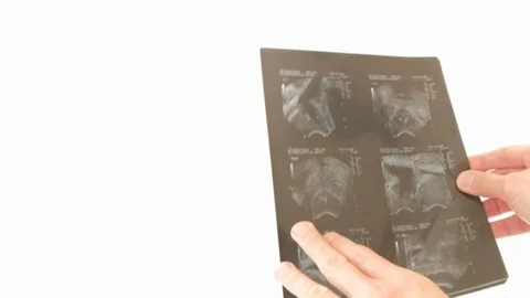 Defocussed close-up view of a doctor examining an X-Ray Video stock 87093629