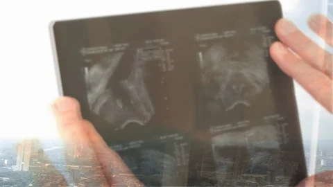 Defocussed reflection of a doctor examining an X-Ray Video stock 87008192