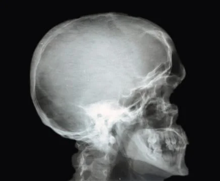 Deformation of the jaw bone Stock Photos