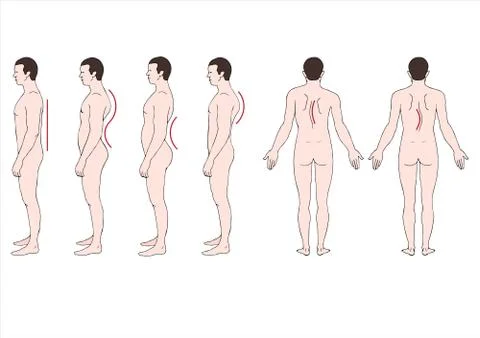 Deformation of the spine  Illustrazione stock