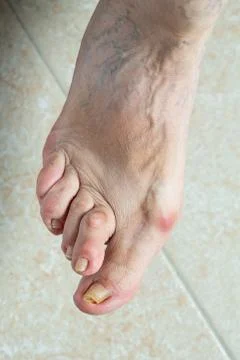 Deformed foot 스톡 사진