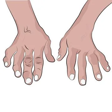 Deformed hands. Stock Illustration