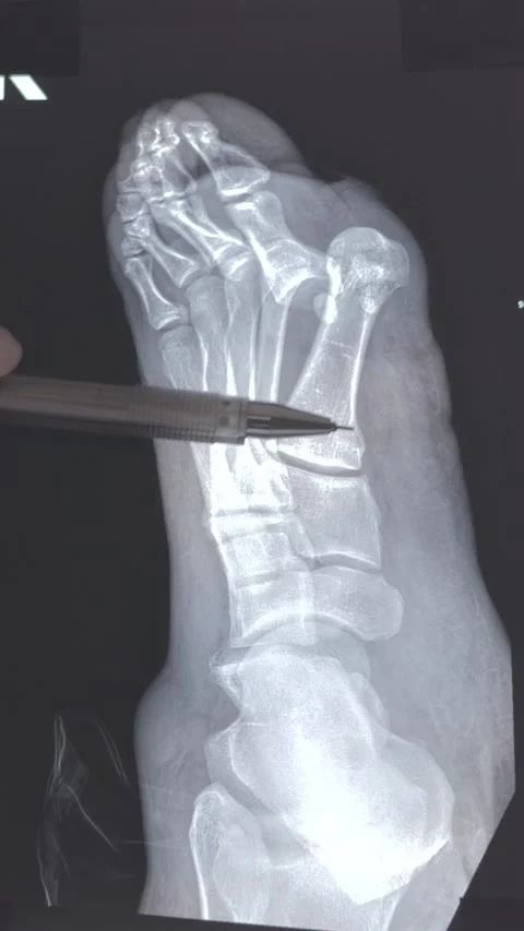 Deformity of the finger Video stock 314430530