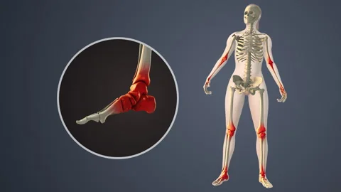 Degenerative Arthritis Affecting Inner Ankle Joint Spaces Stock Footage 313104789