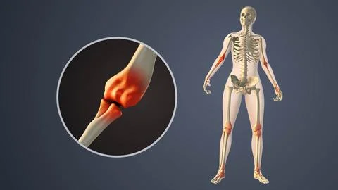 Degenerative Arthritis Affecting Inner elbow Joint Spaces Illustrazione stock