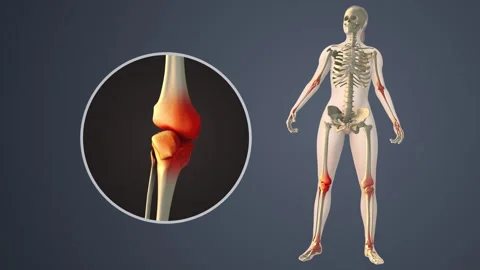 Degenerative Arthritis Affecting Inner knee Joint Spaces Stock Footage 313211459