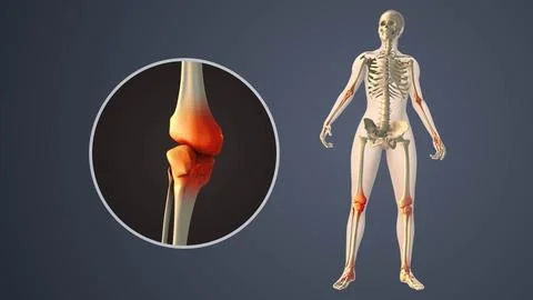 Degenerative Arthritis Affecting Inner knee Joint Spaces Stock Illustration