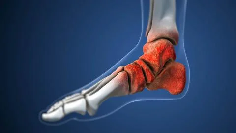 Degenerative Arthritis Impacting the Ankle Area (2) Stock Illustration