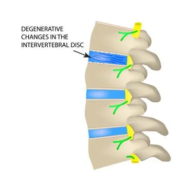 Degenerative changes in the intervertebral disc. Vector illustration on isolated Stock Illustration