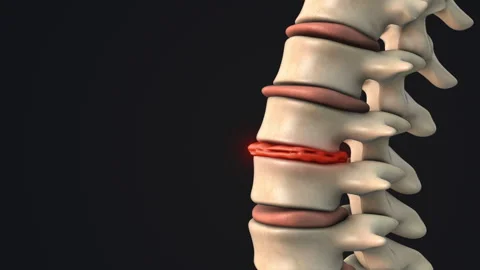 Degenerative disc in the human spine Video stock 274332672