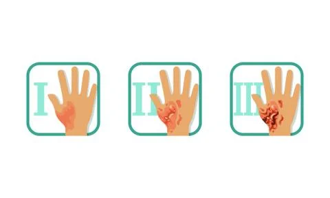 Degree of Skin Burns Set, Normal to Serious Injury, First, Second and Third Stockillustratie