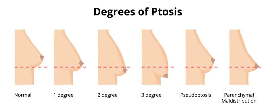 Degrees of breast ptosis grading scale illustration Stock Illustration