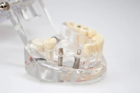 A demonstration jaw with an implants teeth and an abutment Stock Photos
