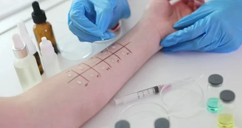 Demonstration of skin allergy testing procedure in clinic Stockbeeldmateriaal 285373271