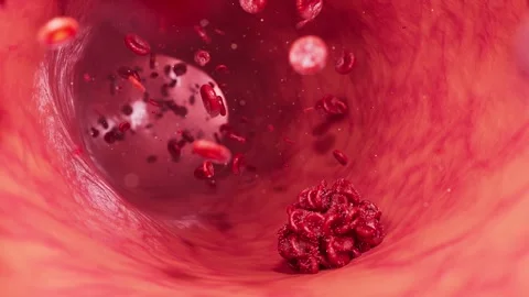 Demonstration of the thrombosis formation process Stock Footage 313860100