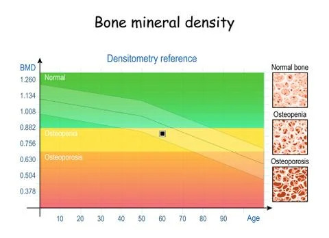 Densitometry reference. Osteopenia and osteoporosis. Aging process Illustrazione stock