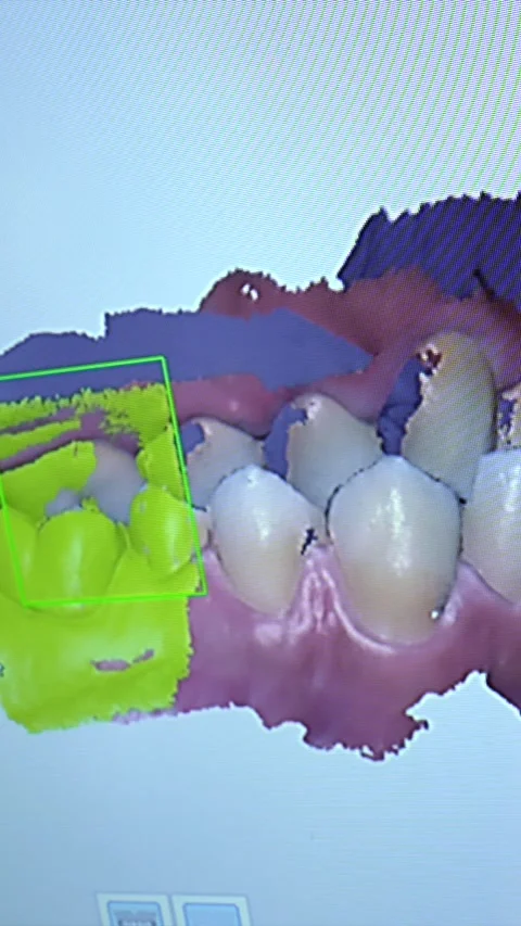 Dental 3d scan showing teeth and gums Stock Footage 306061453