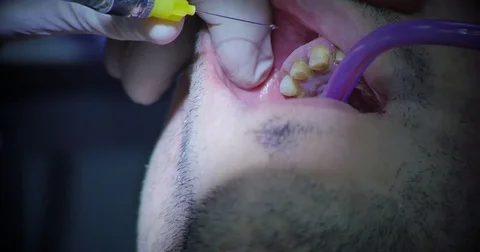 Dental anesthesia Stock Footage 70171941