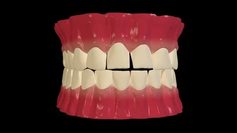 Dental Braces Video stock 129878717