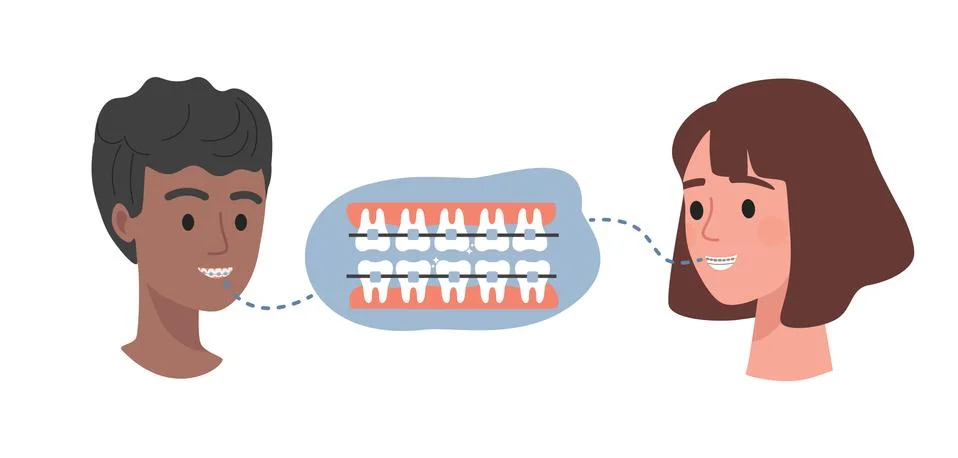 Dental braces on teeth vector flat illustration. Male and female heads and teeth Illustrazione stock