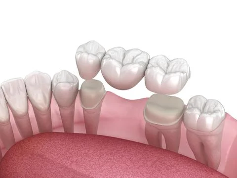 Dental bridge of 3 teeth over molar and premolar. Ilustração Stock