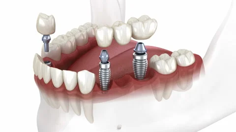 Dental bridge and crown placement over implants. Dental 3D animation concept Stock Footage