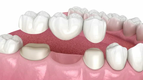 Dental bridge based on 2 teeth. Medically accurate 3D animation Stock Footage 221912342