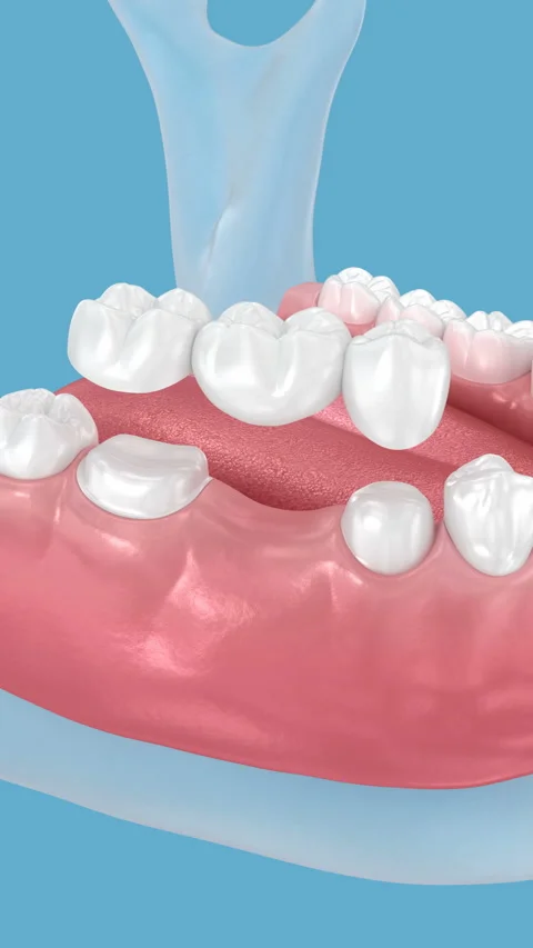 Dental bridge based on 2 teeth. 3D Animation Vidéo 314537826