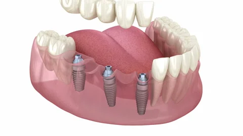 Dental bridge based on 3 implants. Medically accurate 3D animation Stock Footage 129322457