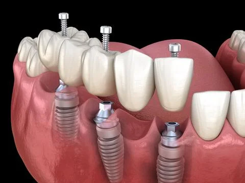 Dental bridge based on 3 implants. Medically accurate 3D illustration Stock Illustration