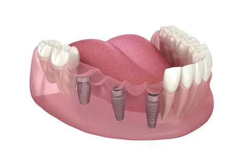 Dental bridge based on 3 implants. Medically accurate 3D illustration 스톡 일러스트