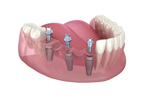 Dental bridge based on 3 implants. Medically accurate 3D illustration Stock Illustration