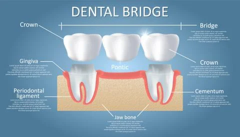 Dental bridge concept vector educational poster, diagram Stock Illustration