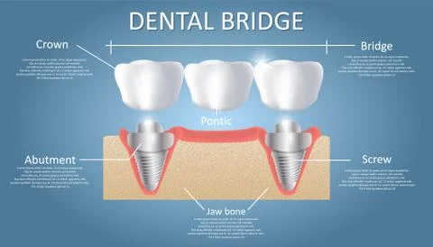 Dental bridge concept vector educational poster, diagram 스톡 일러스트