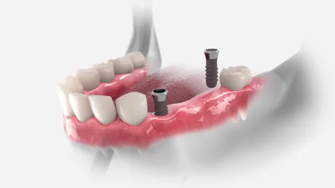 Dental Bridge Stock Footage 138796574