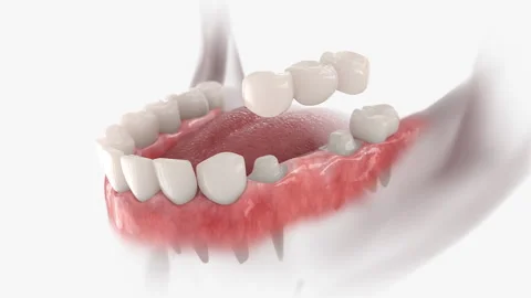 Dental bridge Stock Footage 139091660