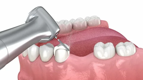 Dental bridge placement. Medically accurate 3D animation Stock Footage 231553355