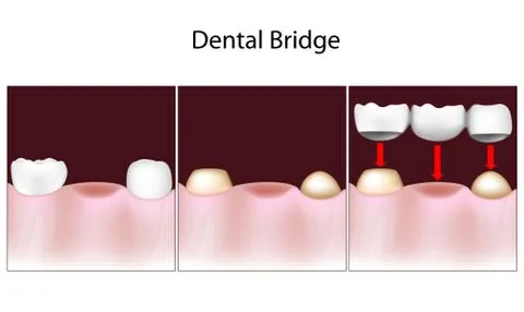 Dental bridge procedure Stock Illustration
