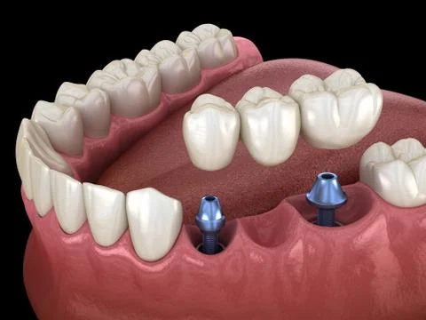 Dental bridge supported by implants. Medically accurate 3D illustration of hu Stock Illustration