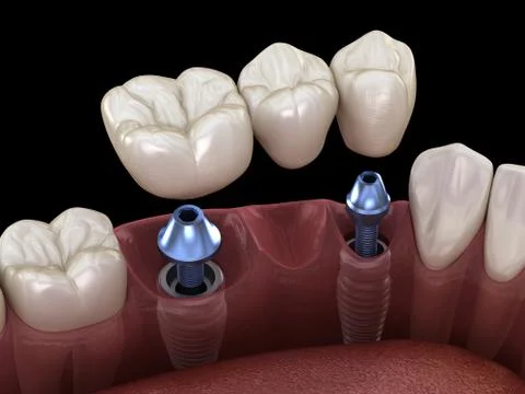 Dental bridge supported by implants. Medically accurate 3D illustration of hu Stock Illustration