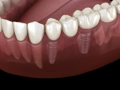 Dental bridge supported by implants. Medically accurate 3D illustration of hu 스톡 일러스트