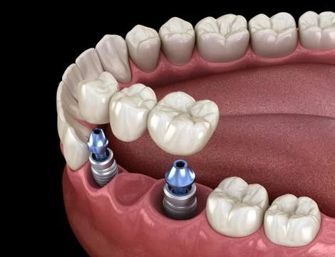 Dental bridge supported by implants. Medically accurate 3D illustration of hu 스톡 일러스트